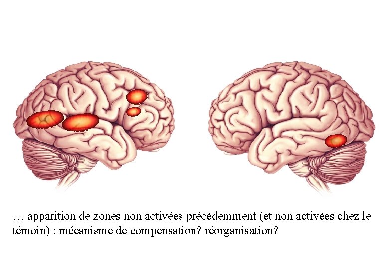 … apparition de zones non activées précédemment (et non activées chez le témoin) :