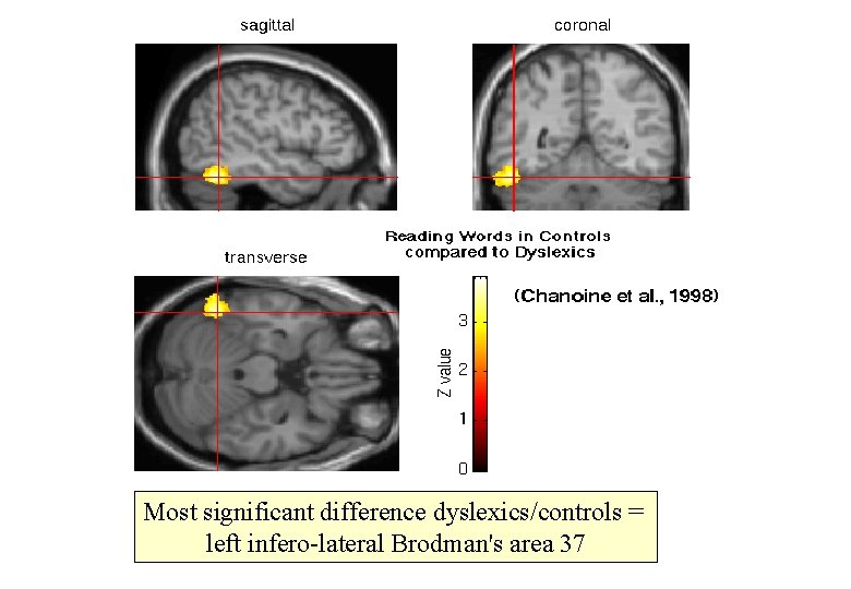 Most significant difference dyslexics/controls = left infero-lateral Brodman's area 37 