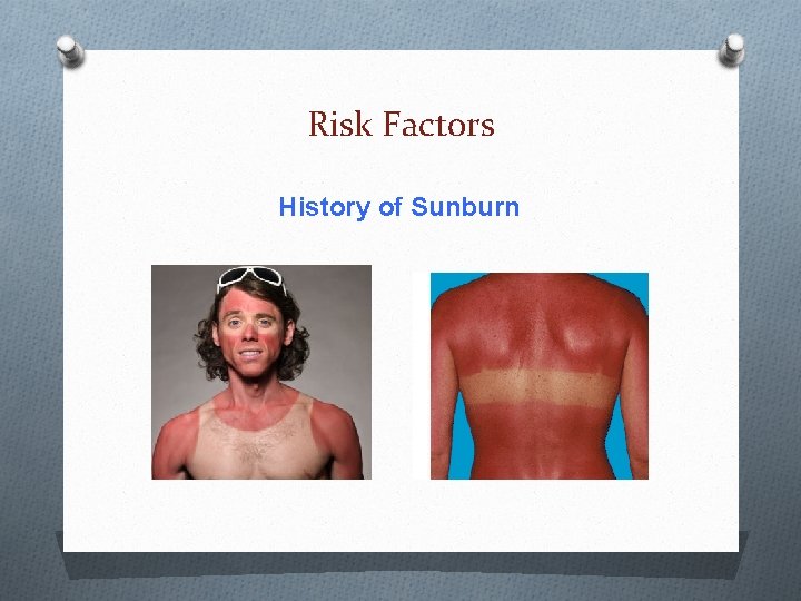 Risk Factors History of Sunburn Risk Factors History of Sunburn