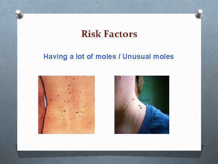 Risk Factors Having a lot of moles / Unusual moles Risk Factors Having a lot of moles / Unusual moles