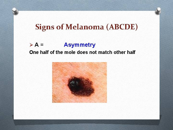 Signs of Melanoma (ABCDE) ØA = Asymmetry One half of the mole does not Signs of Melanoma (ABCDE) ØA = Asymmetry One half of the mole does not