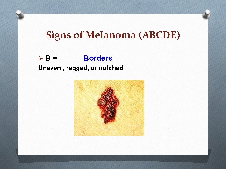 Signs of Melanoma (ABCDE) ØB = Borders Uneven , ragged, or notched Signs of Melanoma (ABCDE) ØB = Borders Uneven , ragged, or notched