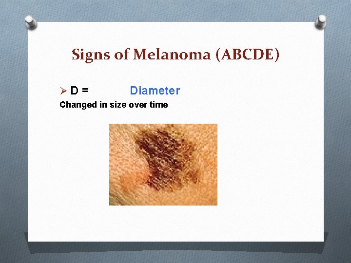Signs of Melanoma (ABCDE) ØD = Diameter Changed in size over time Signs of Melanoma (ABCDE) ØD = Diameter Changed in size over time