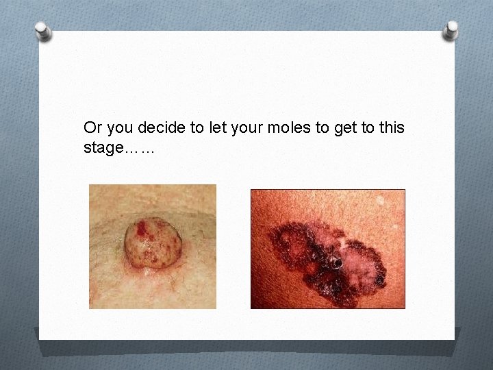 Or you decide to let your moles to get to this stage…… Or you decide to let your moles to get to this stage……