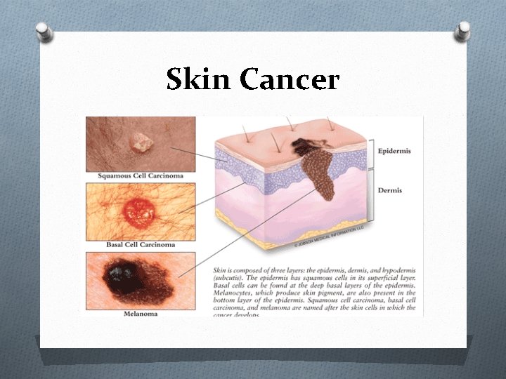 Skin Cancer Skin Cancer