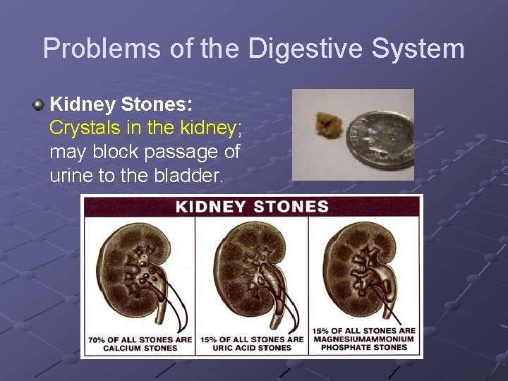 Problems of the Digestive System Kidney Stones: Crystals in the kidney; may block passage