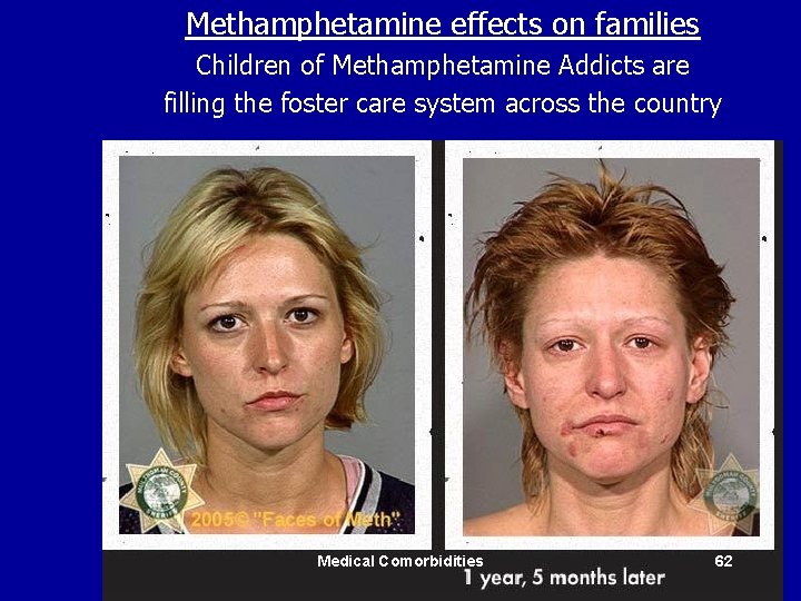 Methamphetamine effects on families Children of Methamphetamine Addicts are filling the foster care system