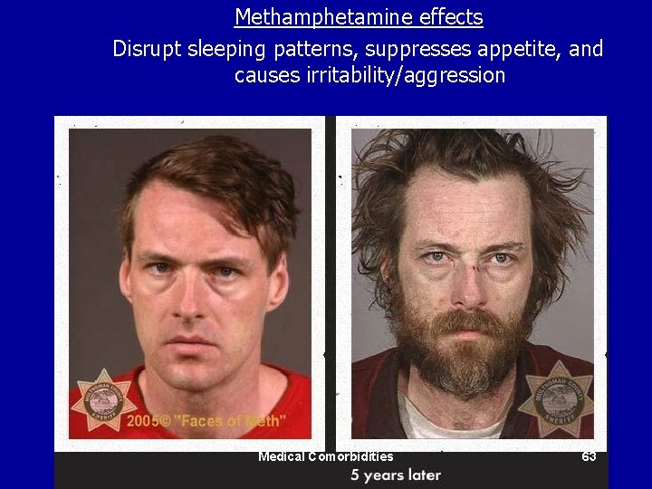 Methamphetamine effects Disrupt sleeping patterns, suppresses appetite, and causes irritability/aggression Medical Comorbidities 63 