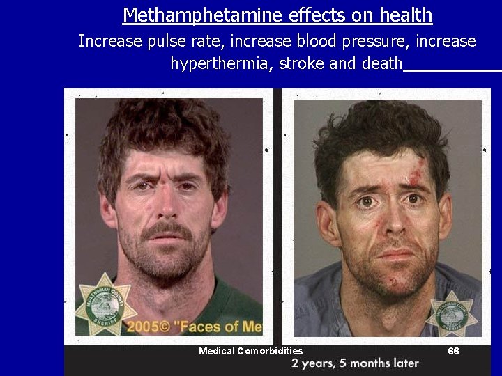 Methamphetamine effects on health Increase pulse rate, increase blood pressure, increase hyperthermia, stroke and