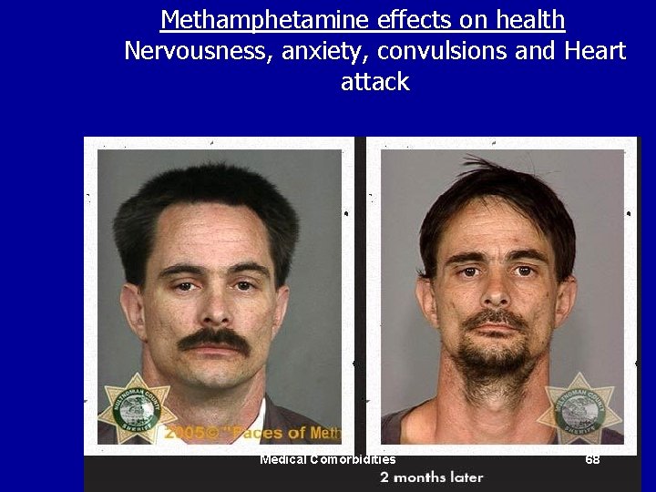 Methamphetamine effects on health Nervousness, anxiety, convulsions and Heart attack Medical Comorbidities 68 