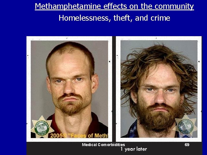 Methamphetamine effects on the community Homelessness, theft, and crime Medical Comorbidities 69 