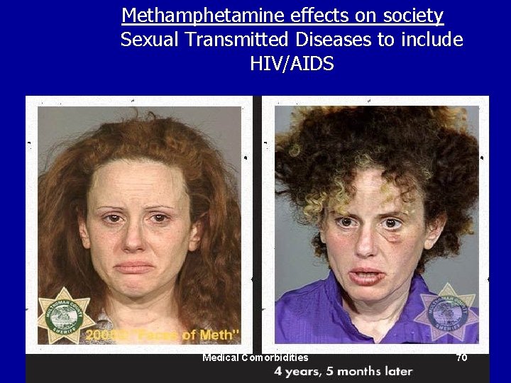 Methamphetamine effects on society Sexual Transmitted Diseases to include HIV/AIDS Medical Comorbidities 70 