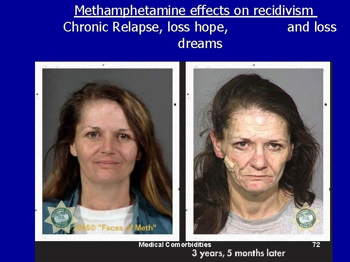 Methamphetamine effects on recidivism Chronic Relapse, loss hope, and loss dreams Medical Comorbidities 72