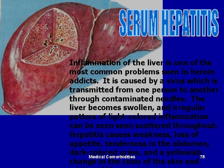 Inflammation of the liver is one of the most common problems seen in heroin