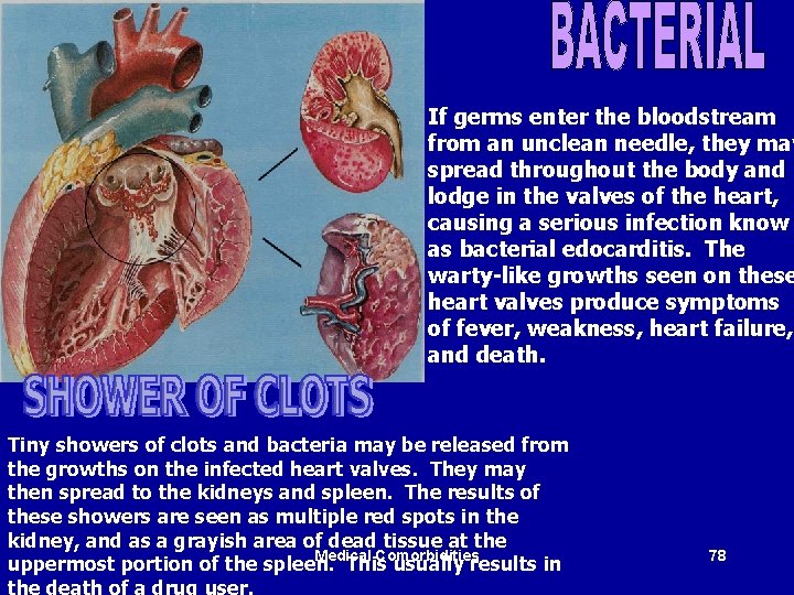 If germs enter the bloodstream from an unclean needle, they may spread throughout the