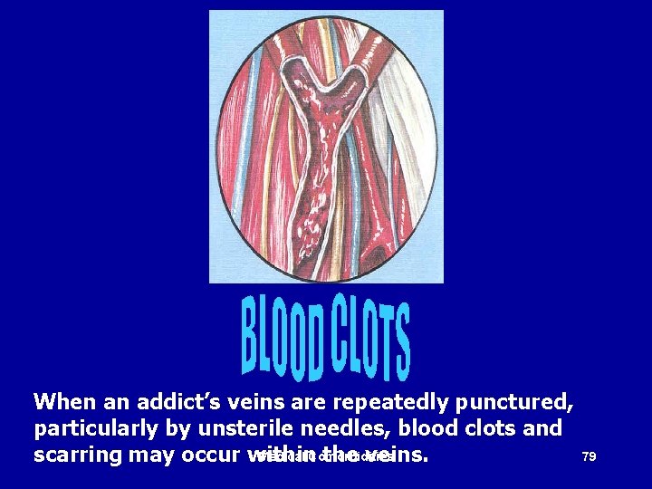 When an addict’s veins are repeatedly punctured, particularly by unsterile needles, blood clots and