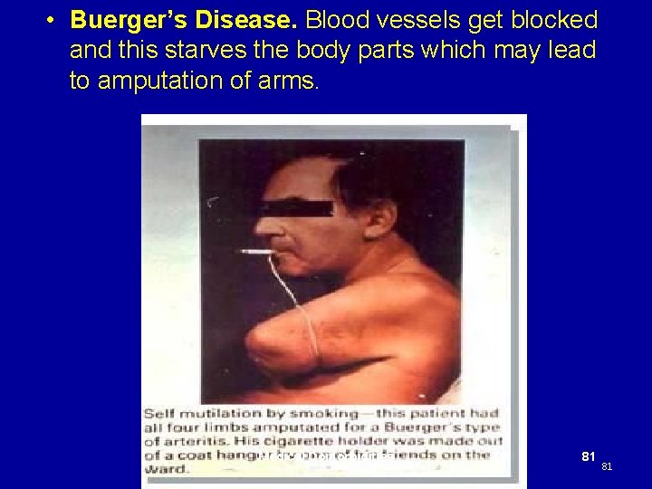  • Buerger’s Disease. Blood vessels get blocked and this starves the body parts