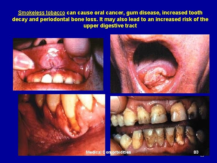 Smokeless tobacco can cause oral cancer, gum disease, increased tooth decay and periodontal bone