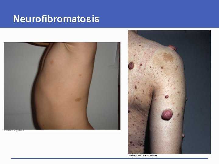 Neurofibromatosis 