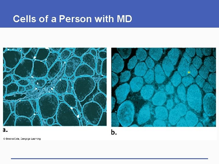 Cells of a Person with MD 