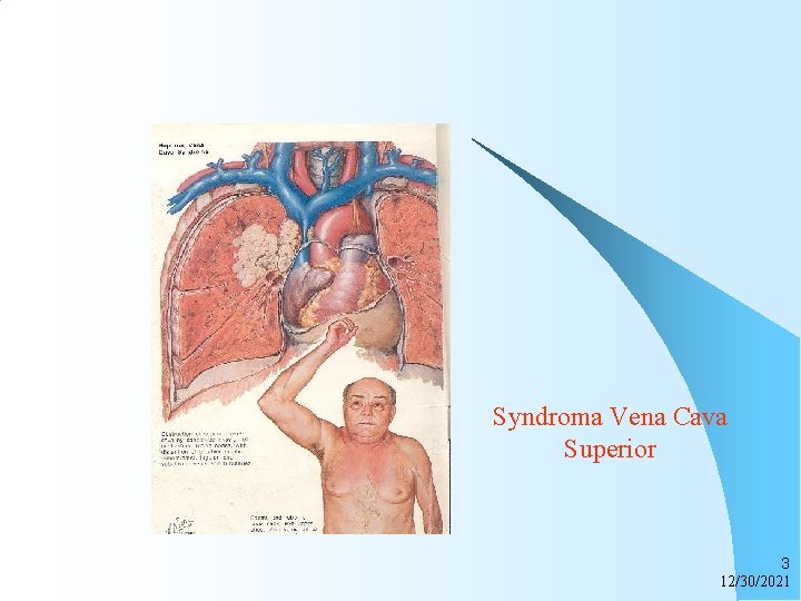 Syndroma Vena Cava Superior 3 12/30/2021 