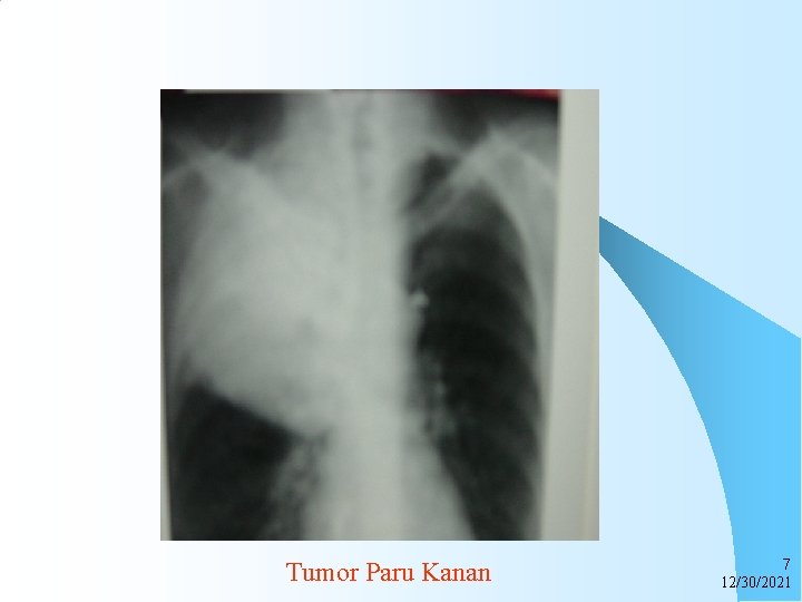 Tumor Paru Kanan 7 12/30/2021 