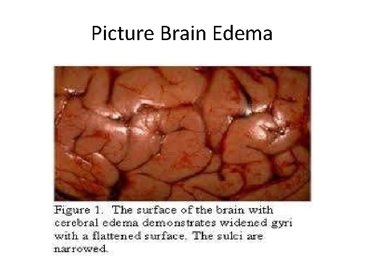 Picture Brain Edema 