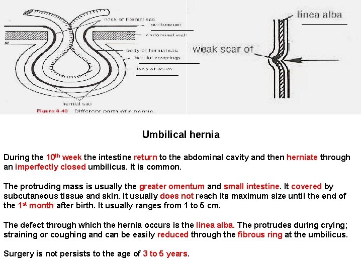 Umbilical hernia During the 10 th week the intestine return to the abdominal cavity