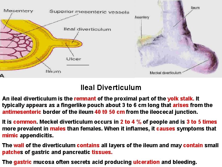 Ileal Diverticulum An ileal diverticulum is the remnant of the proximal part of the