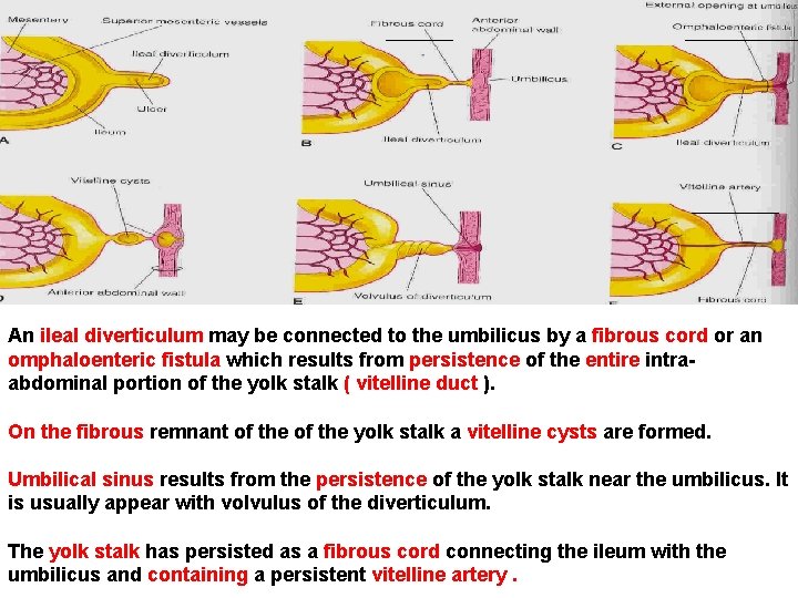 An ileal diverticulum may be connected to the umbilicus by a fibrous cord or