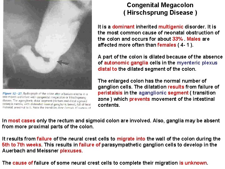 Congenital Megacolon ( Hirschsprung Disease ) It is a dominant inherited multigenic disorder. It