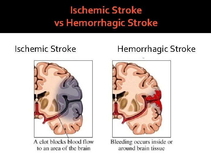 Ischemic Stroke vs Hemorrhagic Stroke Ischemic Stroke Hemorrhagic Stroke 