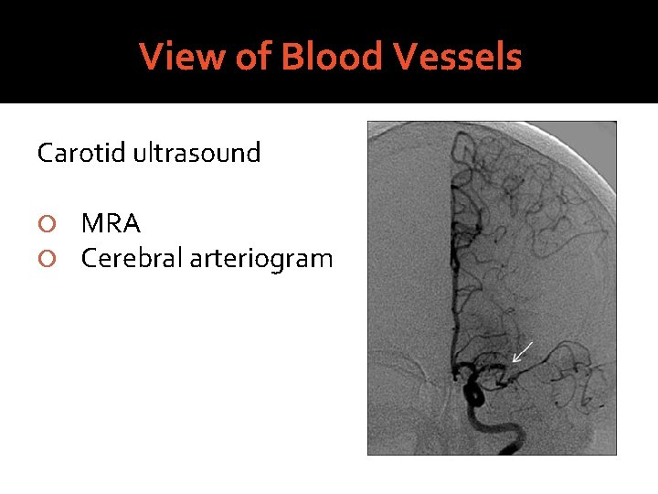 View of Blood Vessels Carotid ultrasound MRA Cerebral arteriogram 