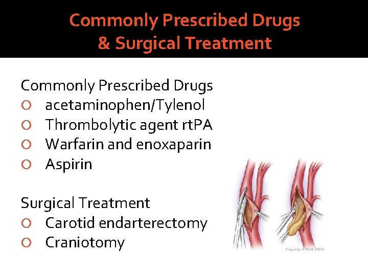 Commonly Prescribed Drugs & Surgical Treatment Commonly Prescribed Drugs acetaminophen/Tylenol Thrombolytic agent rt. PA