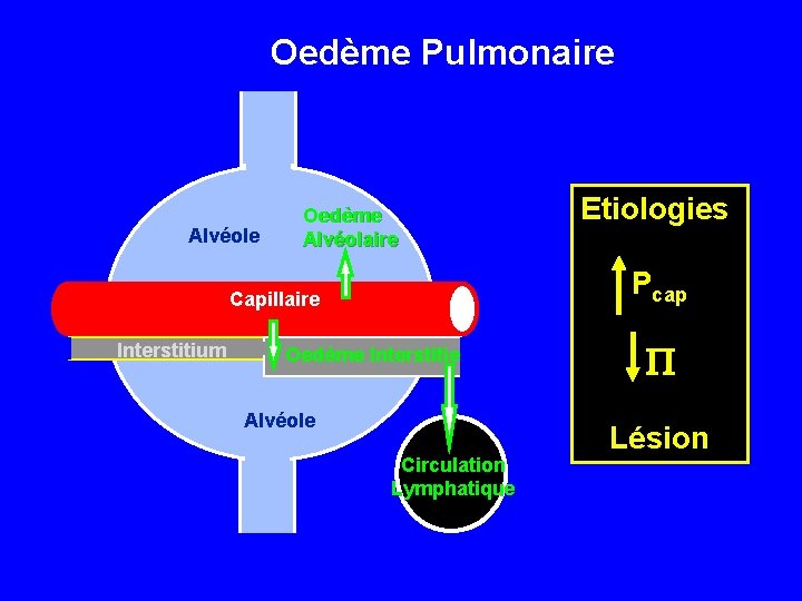 Oedème Pulmonaire Alvéole Oedème Alvéolaire Pcap Capillaire Interstitium Etiologies Oedème Interstitiel Alvéole Circulation Lymphatique