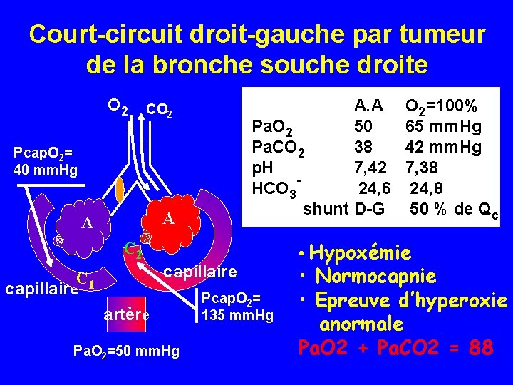 Court-circuit droit-gauche par tumeur de la bronche souche droite O 2 A. A Pa.