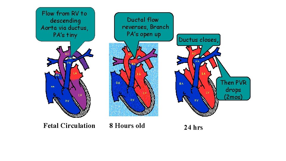 Flow from RV to descending Aorta via ductus, PA’s tiny Ductal flow reverses, Branch