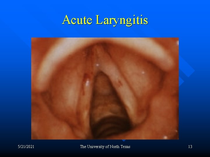 Acute Laryngitis 5/21/2021 The University of North Texas 13 