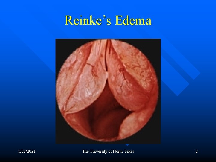 Reinke’s Edema 5/21/2021 The University of North Texas 2 