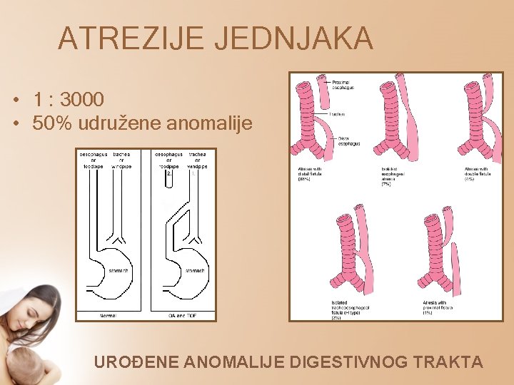 ATREZIJE JEDNJAKA • 1 : 3000 • 50% udružene anomalije UROĐENE ANOMALIJE DIGESTIVNOG TRAKTA