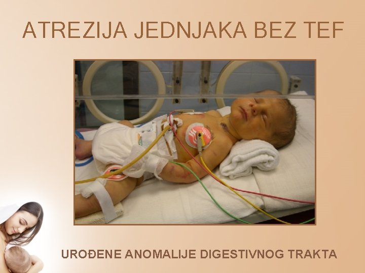 ATREZIJA JEDNJAKA BEZ TEF UROĐENE ANOMALIJE DIGESTIVNOG TRAKTA 