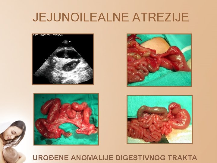 JEJUNOILEALNE ATREZIJE UROĐENE ANOMALIJE DIGESTIVNOG TRAKTA 