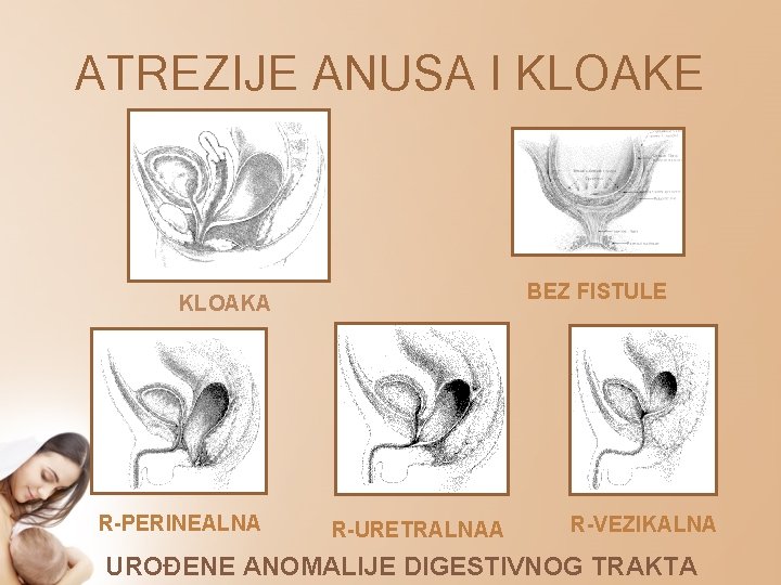 ATREZIJE ANUSA I KLOAKE BEZ FISTULE KLOAKA R-PERINEALNA R-URETRALNAA R-VEZIKALNA UROĐENE ANOMALIJE DIGESTIVNOG TRAKTA