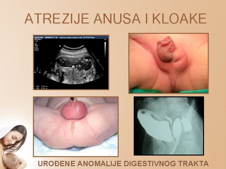 ATREZIJE ANUSA I KLOAKE UROĐENE ANOMALIJE DIGESTIVNOG TRAKTA 