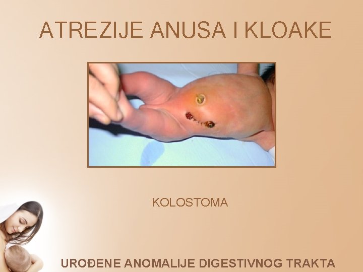 ATREZIJE ANUSA I KLOAKE KOLOSTOMA UROĐENE ANOMALIJE DIGESTIVNOG TRAKTA 