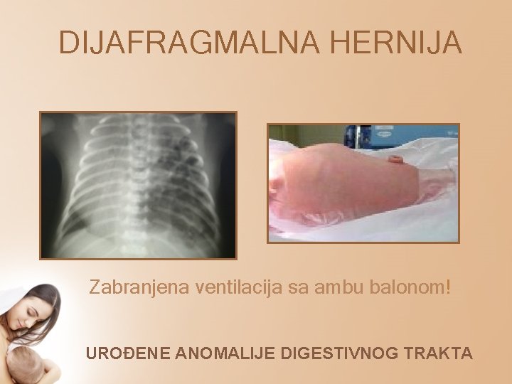 DIJAFRAGMALNA HERNIJA Zabranjena ventilacija sa ambu balonom! UROĐENE ANOMALIJE DIGESTIVNOG TRAKTA 