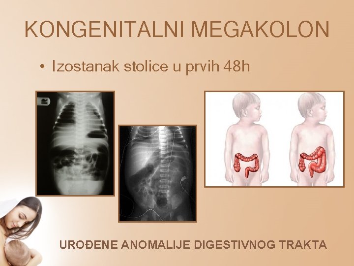 KONGENITALNI MEGAKOLON • Izostanak stolice u prvih 48 h UROĐENE ANOMALIJE DIGESTIVNOG TRAKTA 