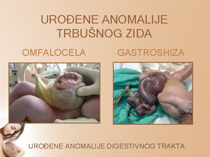 UROĐENE ANOMALIJE TRBUŠNOG ZIDA OMFALOCELA GASTROSHIZA UROĐENE ANOMALIJE DIGESTIVNOG TRAKTA 