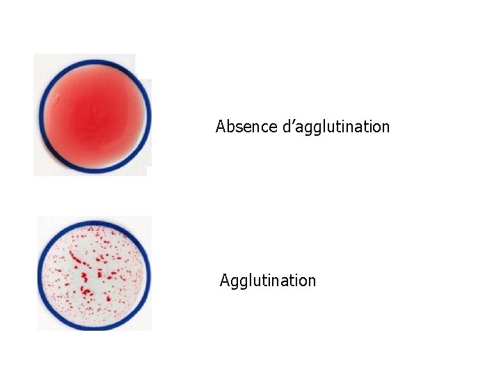 TRANSFUSION Groupes sanguins rythrocytaires systme ABO systme RH