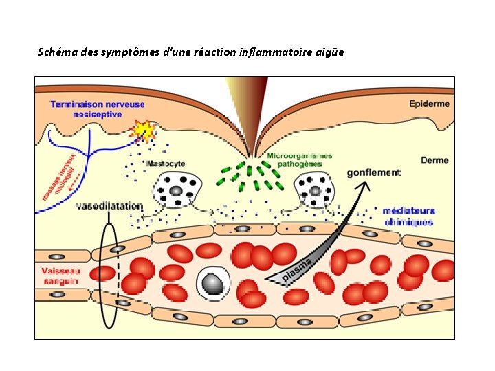 Schéma des symptômes d'une réaction inflammatoire aigüe 